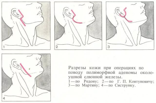 Разрезы при операциях на околоушной слюнной железе. Подчелюстная слюнная железа операция. Разрезы в области околоушной слюнной железы. Опухоль поднижнечелюстной железы. Операции околоушная железа