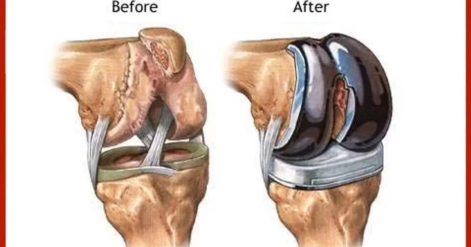 Коленный протез операция. Хондромаляция надколенника упражнения. Замена коленного сустава по квоте. Время восстановления коленного сустава