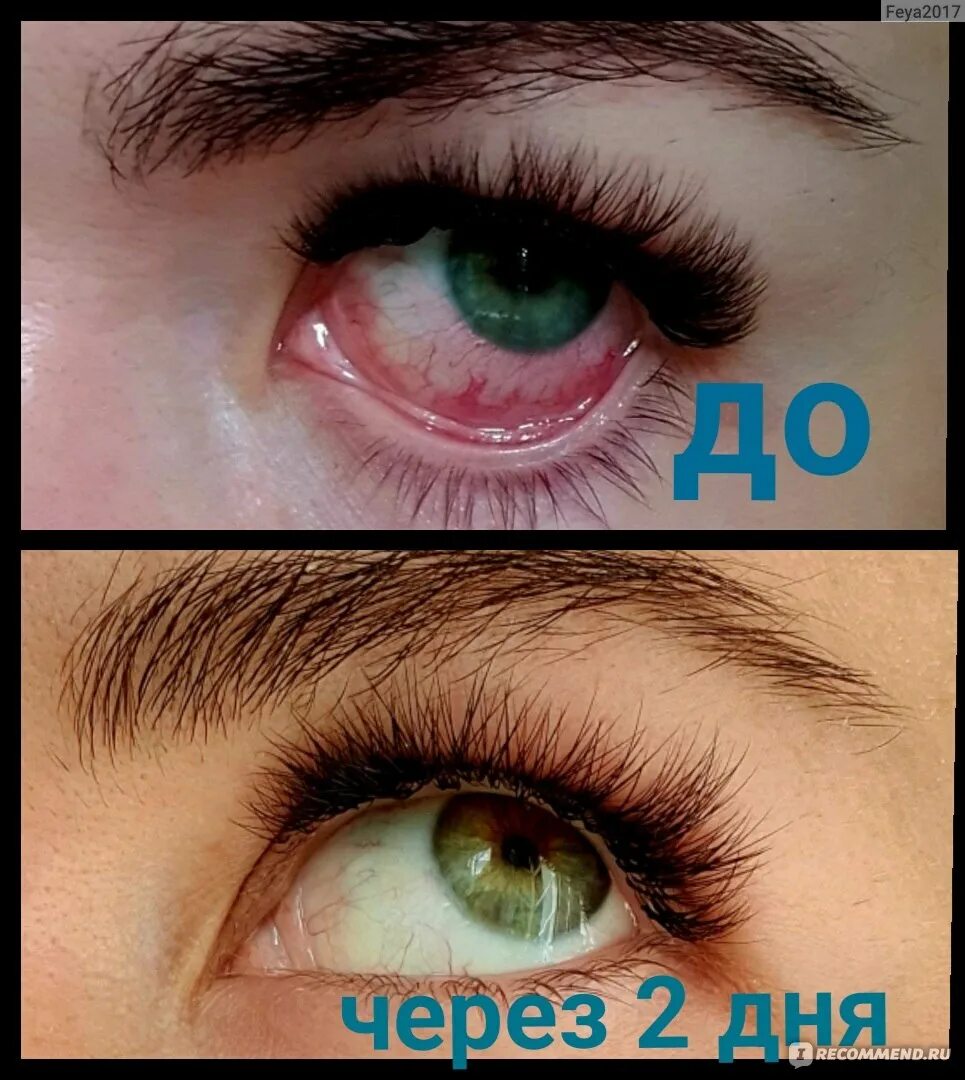 Как убрать красноту после наращивания ресниц. Ожог глаза после наращивания. ожог глаза после наращивания ресниц. сильный ожог глаза после наращивания. глаз болит после косметики.