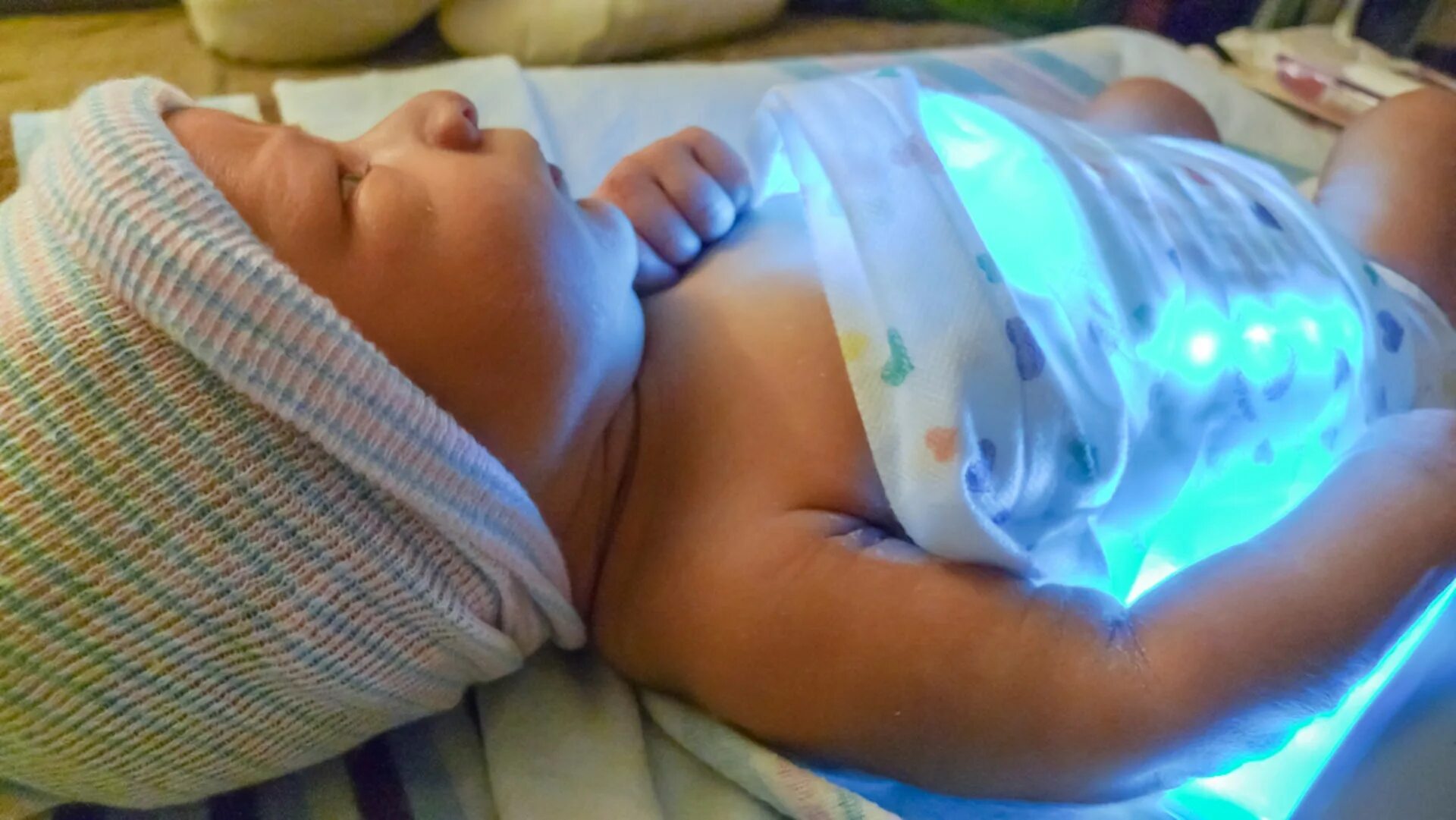 Желтуха у ребенка новорожденного. Фототерапия для новорожденных. Желтушка у новорожденных фото.