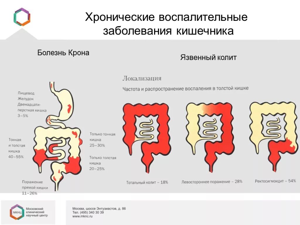 Проблема с кишечником анализы. Язвенный колит поражение кишки. Няк воспаление кишечника. Няк поражение Толстого кишечника.