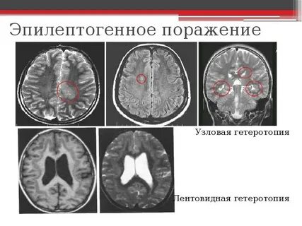 Гетеротопия серого вещества