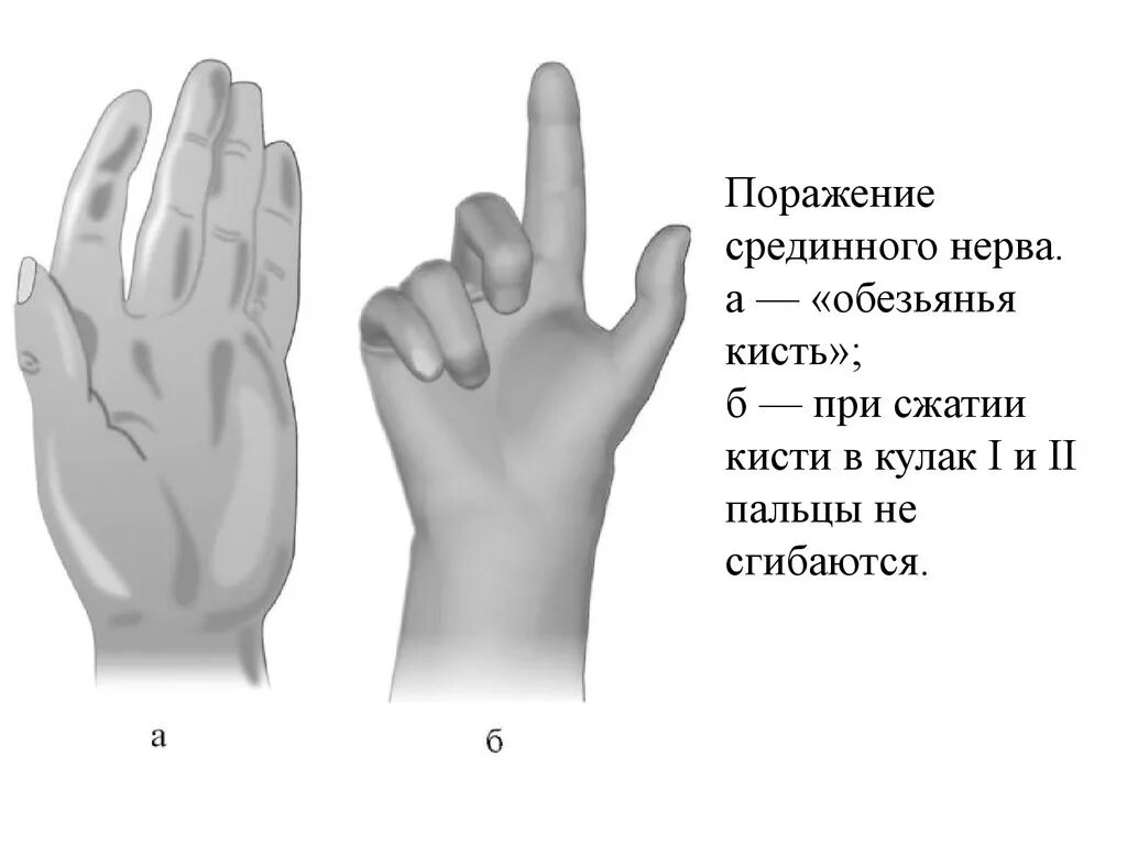 Невропатия нерва руки. Основные симптомы поражения срединного нерва. Поражение срединного нерва Обезьянья кисть. Обезьянья лапа симптом поражения срединного нерва. Синдромы поражения срединного нерва.