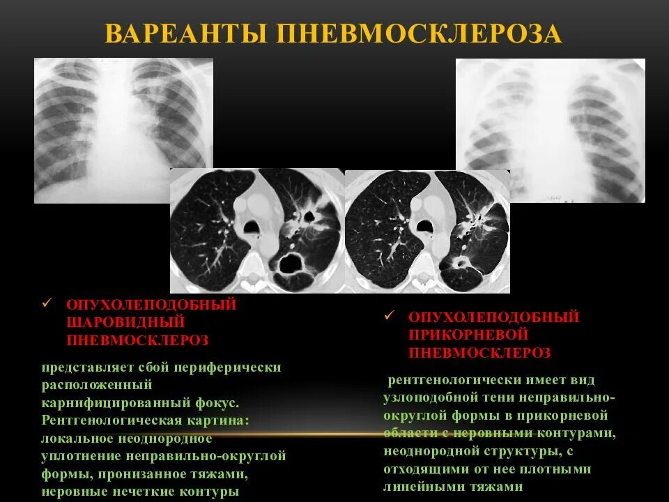 Сколько живут с пневмосклерозом