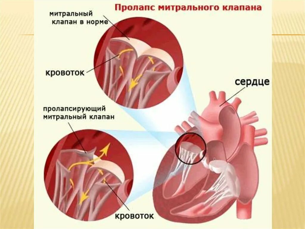 Дегенерация митрального клапана. Пролапс передней створки митрального клапана 1 степени. Пролапс нейтрального клапана сердца 1 степени. Пролабирование створок митрального клапана 1 степени что это. Пролапс центрального клапана сердца 1 степени.