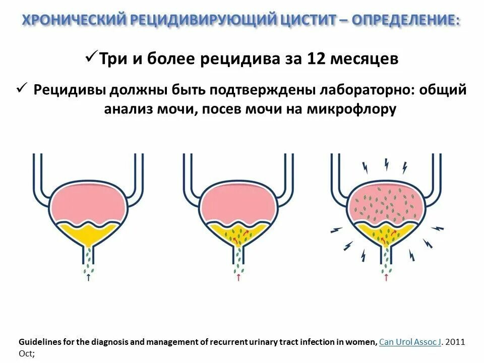 Цистит появление. Проявление цистита. Женский цистит. Цистит причины симптомы. Лёгкая форма цистита у женщин.