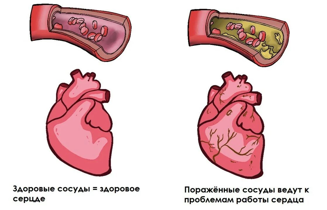 Как лечить атеросклероз сердца. Атеросклеротическая болезнь сердца. атеросклероз аорты и коронарных артерий. ибс атеросклероз аорты и коронарных артерий.
