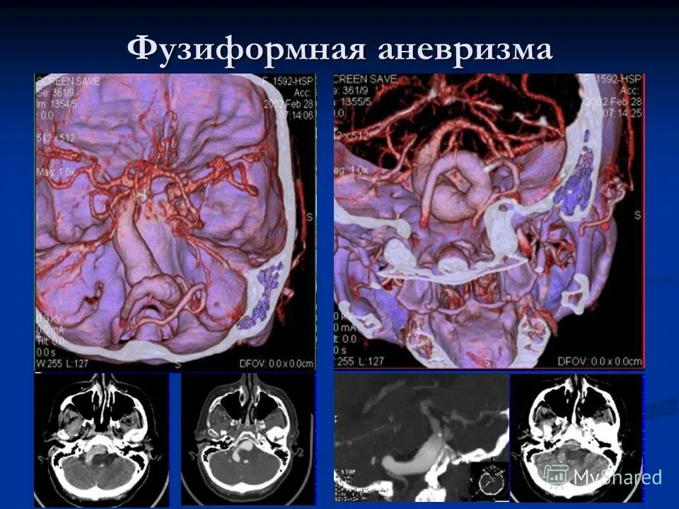 Фузиформная аневризма средней мозговой артерии кт. Фузиформное расширение основной артерии. Фузиформная аневризма основной артерии кт. Аневризма базилярной артерии кт. Аневризма мозга простыми словами