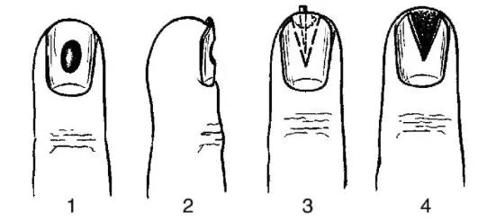 подногтевой панариций операция. подкожный и подногтевой панариций. вскрытие ногтя. стрептококковая паронихия. паронихий панариций пандактилит.
