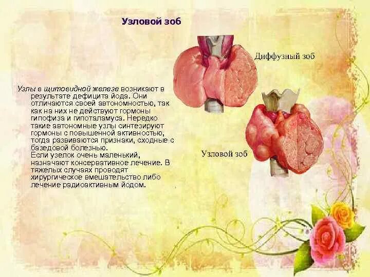 Зоб еда. Диета при узловом зобе. питание при зобе щитовидной железы узловом.