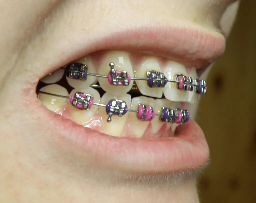 Brackets 2025