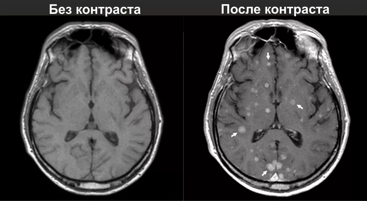 Мрт головного мозга с контрастированием. Опухоль головного мозга на мрт без контраста. Опухоль головного мозга снимок мрт. Метастазы в головном мозге на мрт с контрастом.