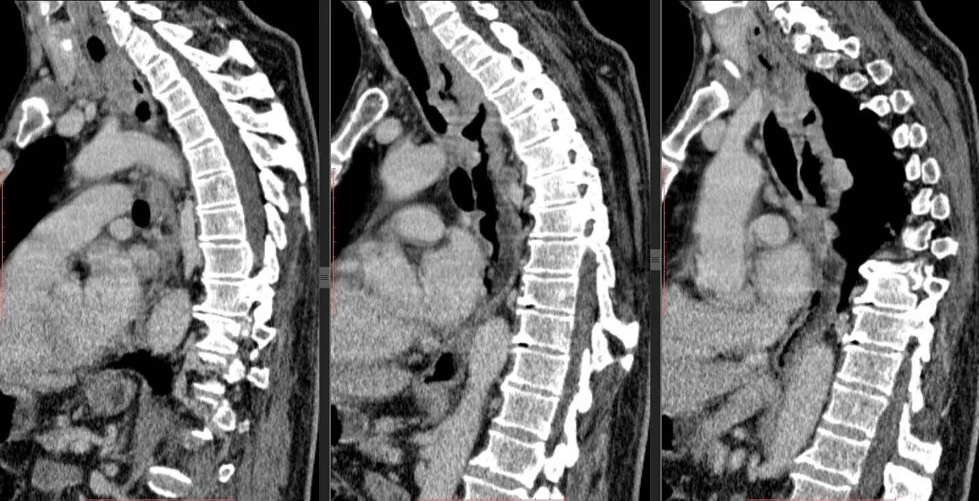 Пищевода 4 стадия. Метастазы в позвоночнике на кт.