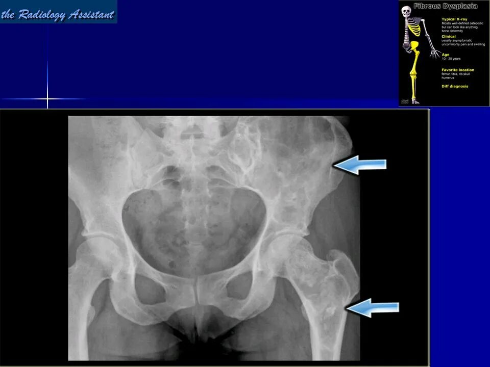 Кт подвздошной кости. Фиброзная дисплазия костей таза рентген. Фиброзная остеодисплазия кт. Фиброзная дисплазия подвздошной кости на кт.