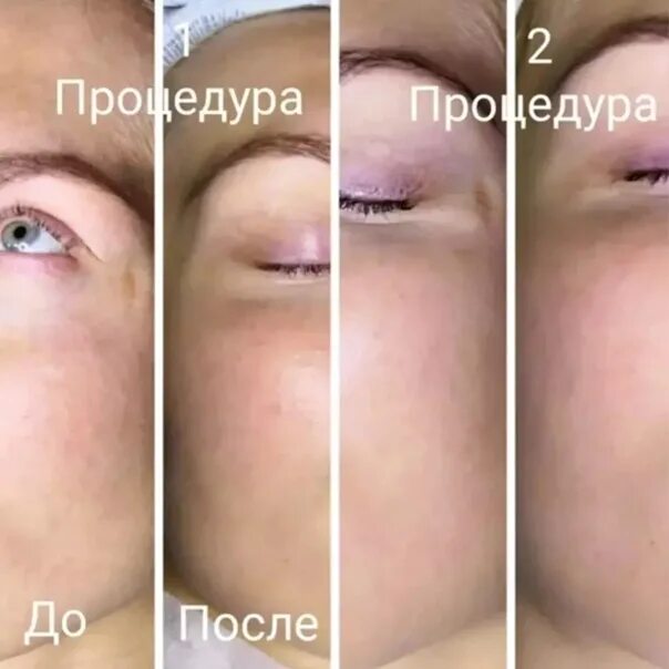 Фарфоровая кукла процедура. Косметические процедуры для лица. Пилинг. Фонофорез фарфоровая кукла. Фарфоровая кукла лица до после.