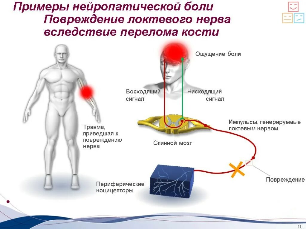Нисходящий нерв. Что такое нейролептические боли. Примеры нейропатической боли. Невропатическая и нейропатическая боль. Схема нейропатической боли.
