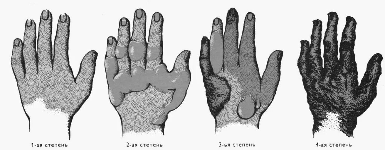 Степень ожогов электротравма. Ожог 1 степени электротравмы. Тепловое поражение током