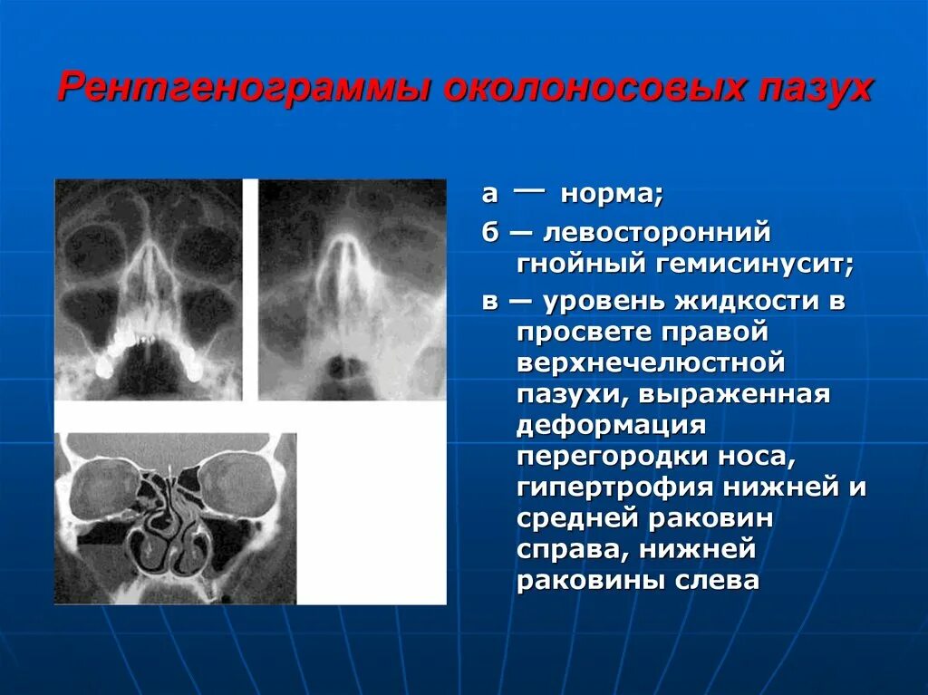 Уровень гайморовой пазухи