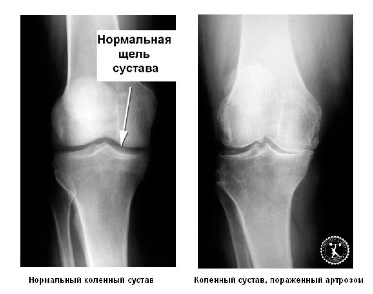 Артроз сустава рентген