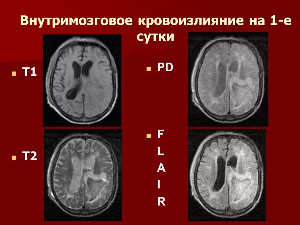 Внутримозговое кровоизлияние. Внутримозговое кровоизлияние мрт. Внутримозговое кровоизлияние кт. Острейшее кровоизлияние на кт.