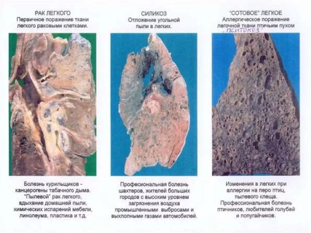 Очищаются ли легкие. Болезнь легких силикоз. Силикоз профессиональное заболевание.