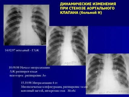 Клапан пациента