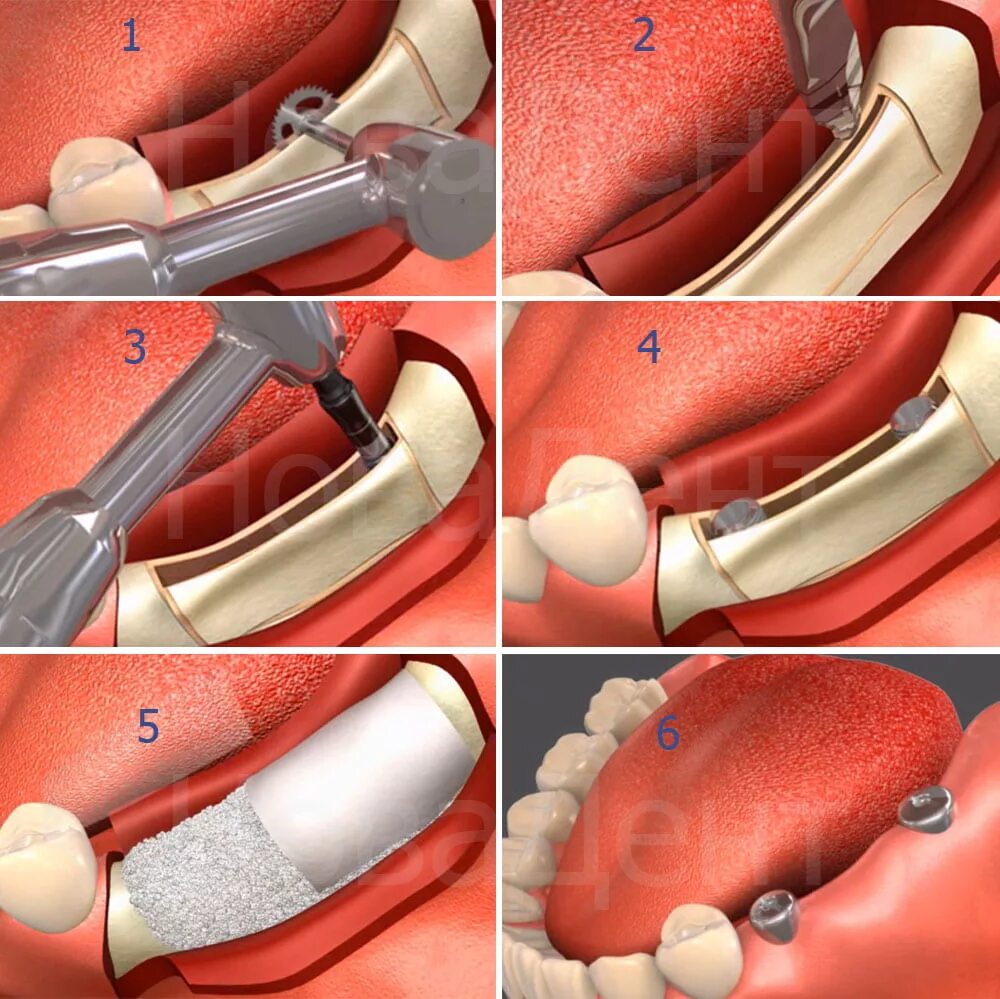 Костная аугментация челюсти. Пластика альвеоралтного гоеьея. Остеопластика альвеолярного гребня. Костная пластика альвеолярного отростка. Имплантация sup aznona com