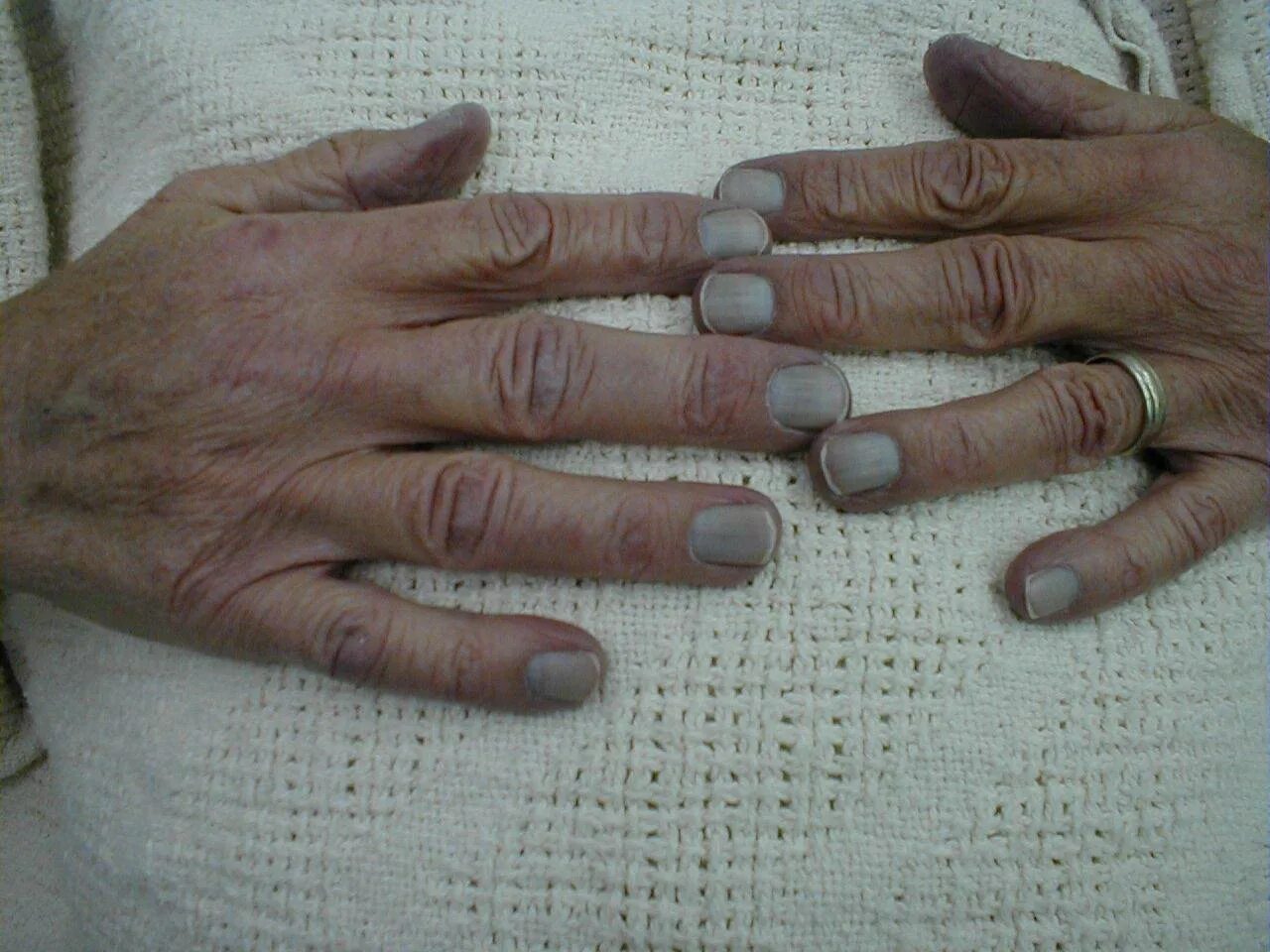 От чего синеют ногти