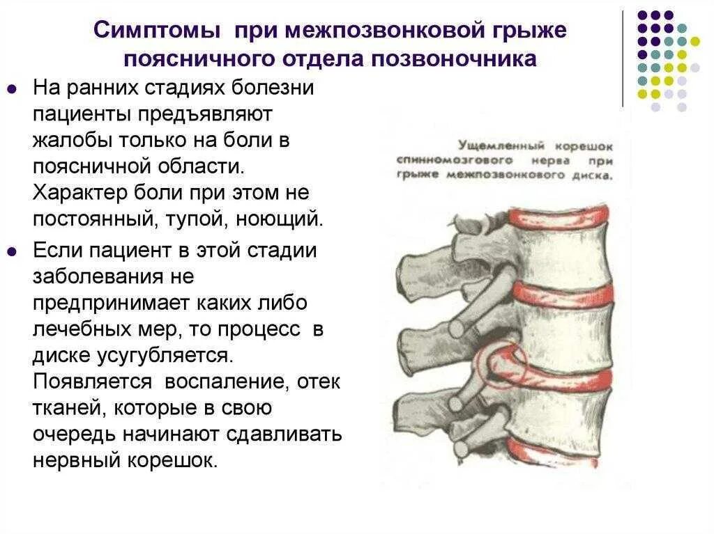 Межпозвонковая грыжа поясничного лечение. Грыжа позвоночника поясничного отдела симптомы. Межпозвоночная грыжа симптомы. Симптомы грыжи поясничного отдела л1 л2. Междисковая грыжа поясничного отдела.