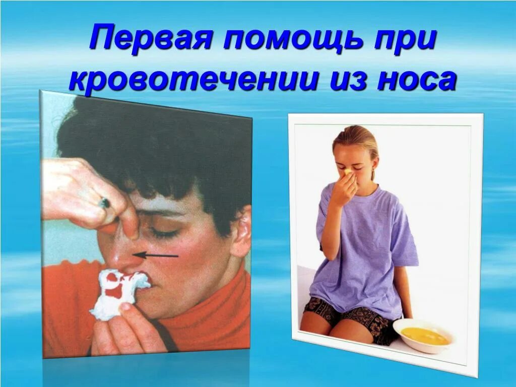 Оказание первой помощи при носовом кровотечении. Оказание первой помощи при кровотечении из носа. При кровотечении из носа. При носовом кровотечении необходимо.