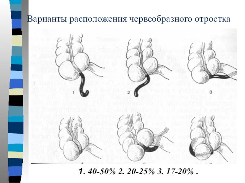 Острый аппендицит локализации отростка. Ретроцекальный аппендицит расположение. Катаральная стадия острого аппендицита. Варианты расположения аппендикса. Локализация острого аппендицита