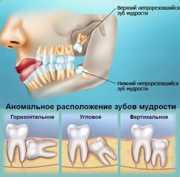 Зуб мудрости на верхней челюсти. Гре растуь зубы мудрлсти. Сколько зубов мудрости может быть у человека