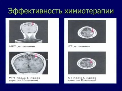 Год после химиотерапии