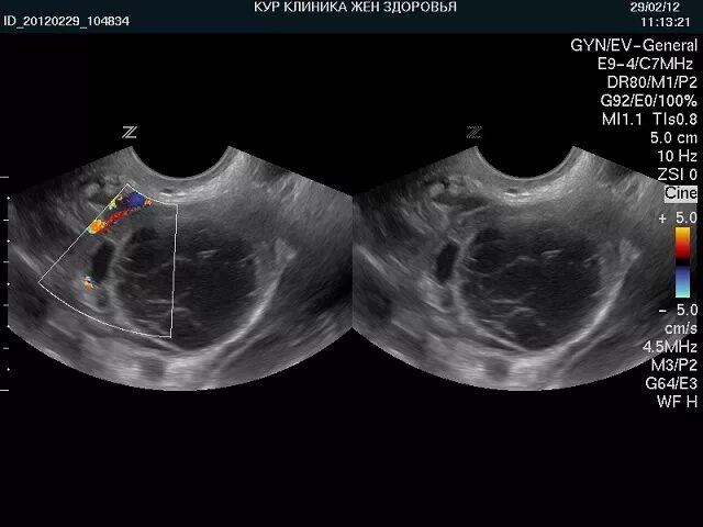 узи показало кисту яичника. текалютеиновые кисты яичников на узи. узи снимок кисты яичника. фолликулярная киста яичника на узи. дермоидные кисты яичника узи.