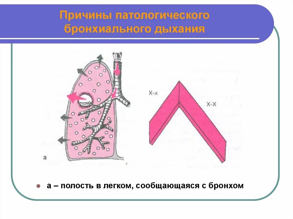 Образование полостей в легких