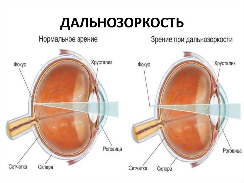 Миопия что это такое у детей. Строение глаза при миопии высокой степени. Дальнозоркость и близорукость строение глаза. Анатомия глаза близорукость и дальнозоркость. Сложный гиперметропический астигматизм 1 степени.