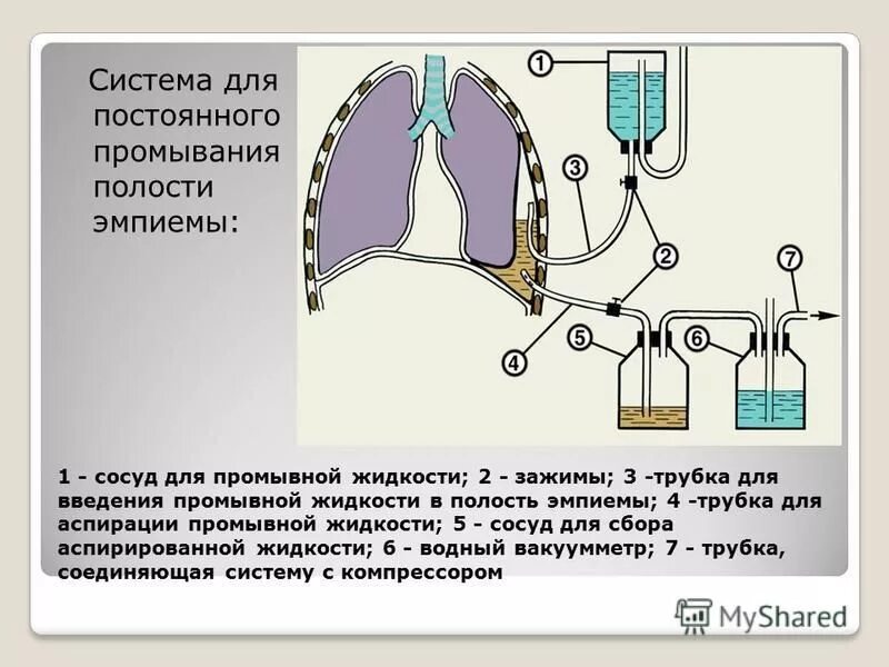 Откачивают жидкость из легких. Пневмоторакс торакоцентез. Плевральный выпот при хсн. Как часто можно откачивать жидкость. Лапароцентез при асците техника.