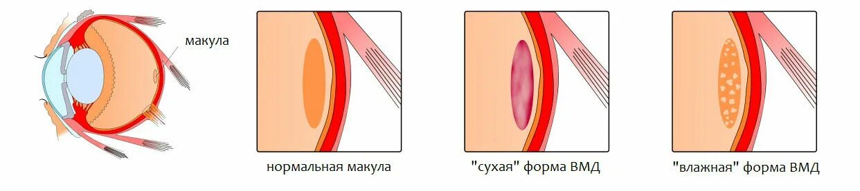 Макула и задний полюс. Макулодистрофия, макулярная дегенерация. макула дистрофия сетчатки. макула дистрофия сетчатки глаза что это такое. возрастная макулярная дистрофия.