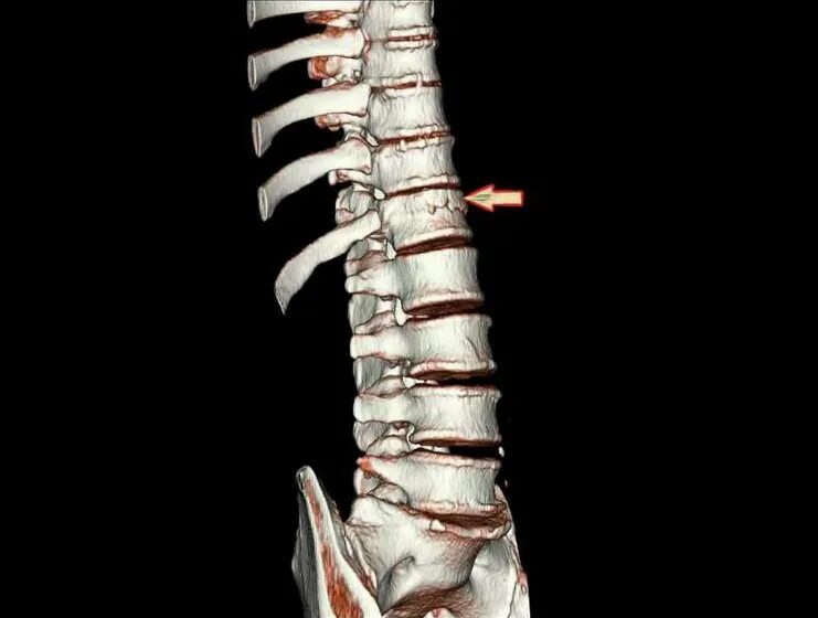 Кт грудного отдела позвоночника. МСКТ грудного отдела позвоночника. Кт грудной позвоночник. Компьютерная томография позвоночника.