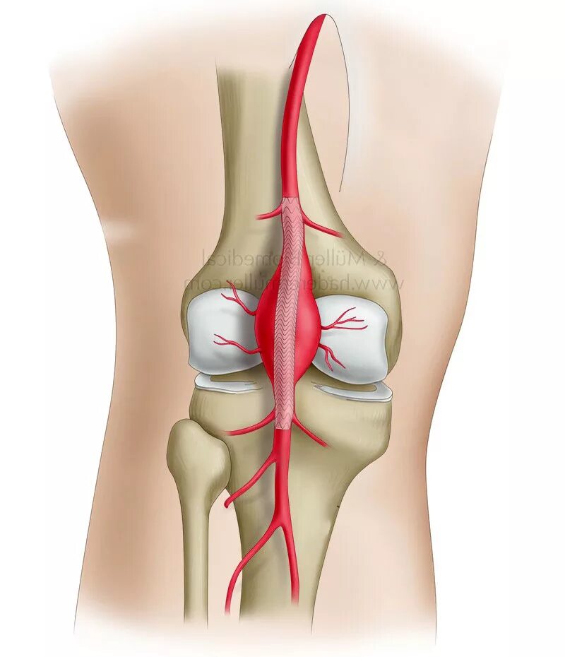 Подколенная аневризма. Аневризма подколенной вены. Аневризма бедренной артерии. Аневризмы подколенной артерии. Сосуды коленного сустава