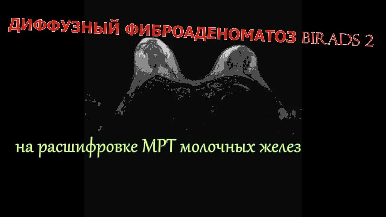 Диффузный фиброаденоматоз молочных желез что это такое. Что такое диффузный фиброаденоматоз молочных желез birads 2. Диффузный фиброаденоматоз молочных желез bi-rads 2 что это такое. Мрт молочных желез фиброаденоматоз. Диффузный Фам молочной железы.