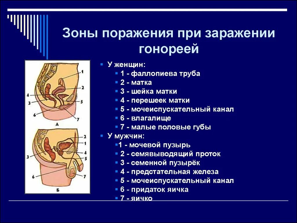 Зоны поражения при заражении гонореей. Гонорейные заболевания женских половых органов. Заболевания органов половой системы