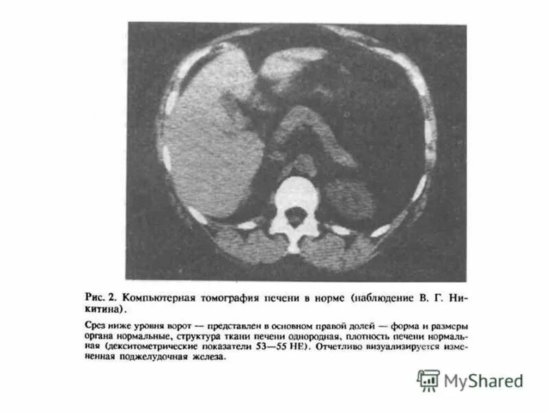 Денситометрическая плотность печени норма. Паренхима печени денситометрическая плотность. Плотность печени на кт норма. Плотность паренхимы печени снижена. Кт печени норма.