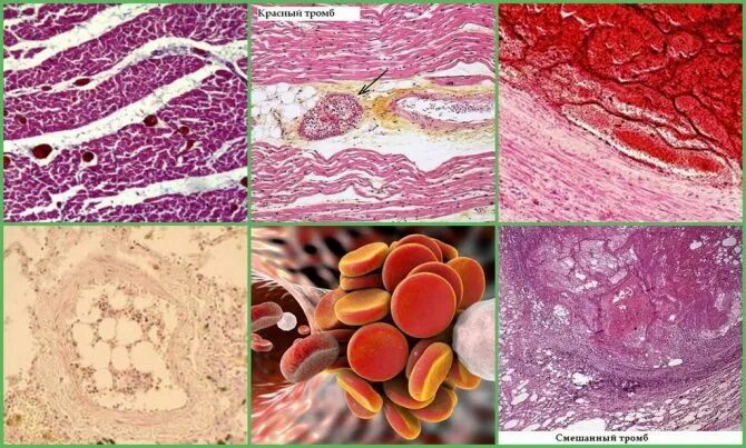 Белый тромб гистология. Белый тромб в артерии микропрепарат. Части тромбов