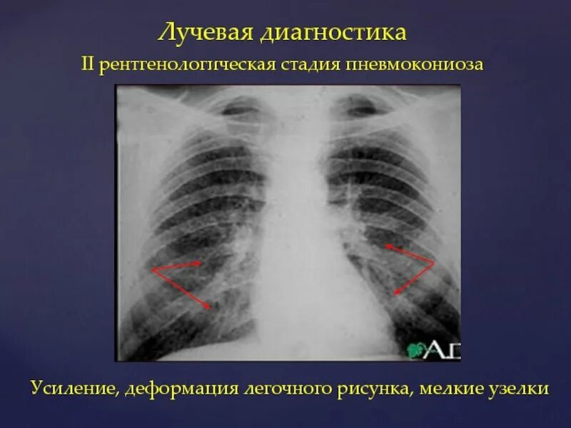 Легочный рисунок диффузно деформирован