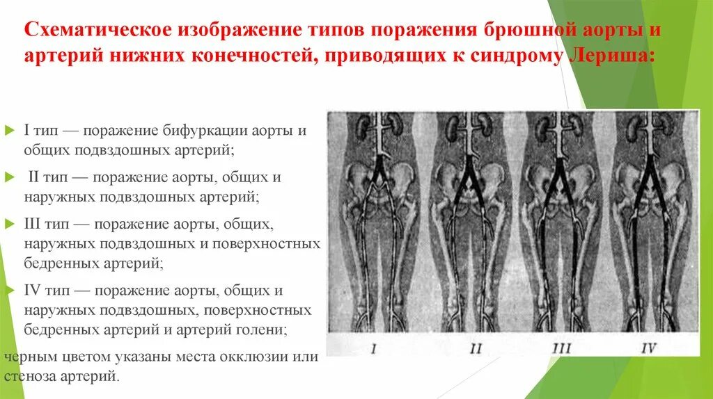 Аорты нижних конечностей. Синдром поражения бифуркации аорты. Окклюзия бифуркации аорты.