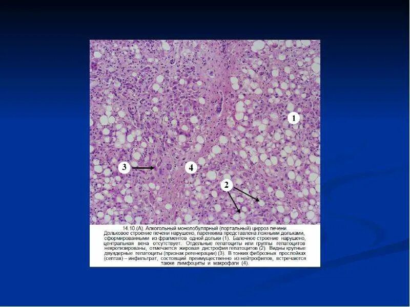 Вирусный мультилобулярный цирроз печени микропрепарат. Алкогольный монолобулярный цирроз печени микропрепарат. Постнекротический цирроз печени патанатомия. Постнекротический вирусный цирроз печени микропрепарат. Печень микропрепарат описание