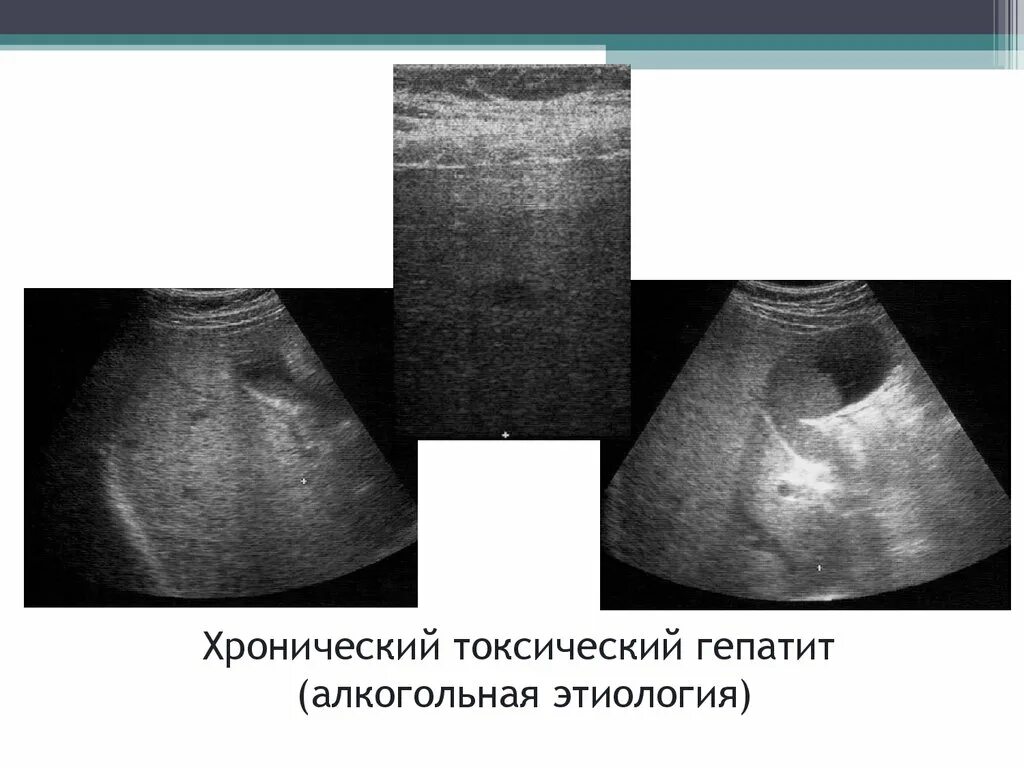 Токсический печени симптомы. Хронический алкогольный гепатит УЗИ. Токсический гепатит УЗИ печени. Хронический гепатит на УЗИ. УЗИ печени при токсическом гепатите.