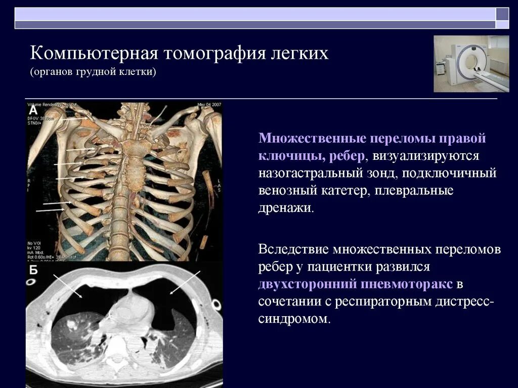 Насколько вредно кт. Кт исследование грудной клетки. Компьютерная томография кт грудной клетки. СКТ органов грудной клетки.