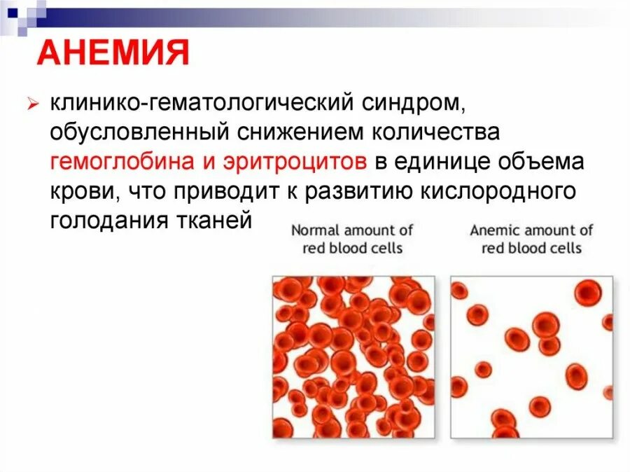 Количество эритроцитов при анемии. Эритроциты в крови анемия. Малокровие 6